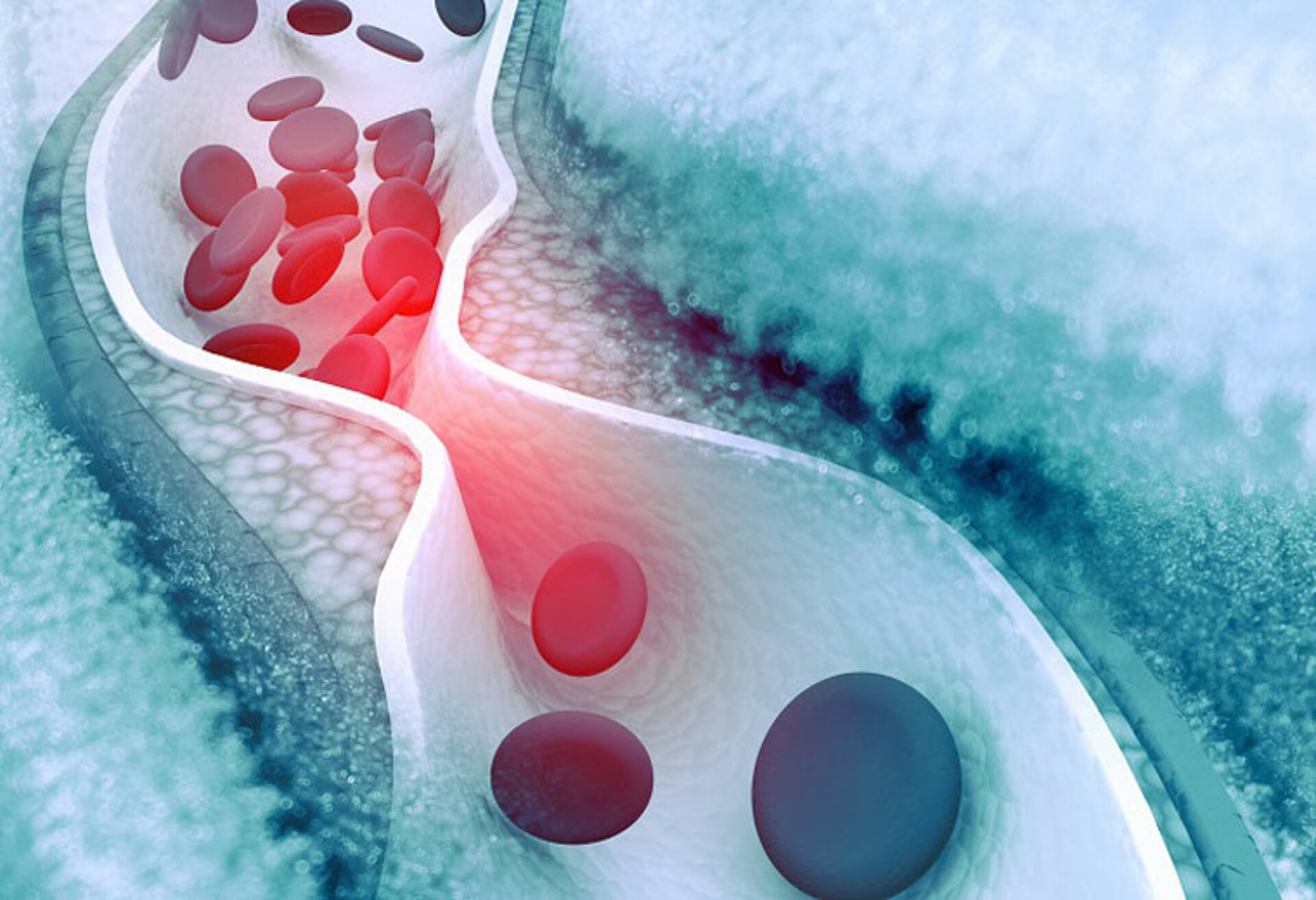 Arteriosklerose – verengtes Blutgefäß Verengtes Blutgefäß mit eingeschränktem Blutfluss – Symbolbild für Arteriosklerose und relevante Biomarker.