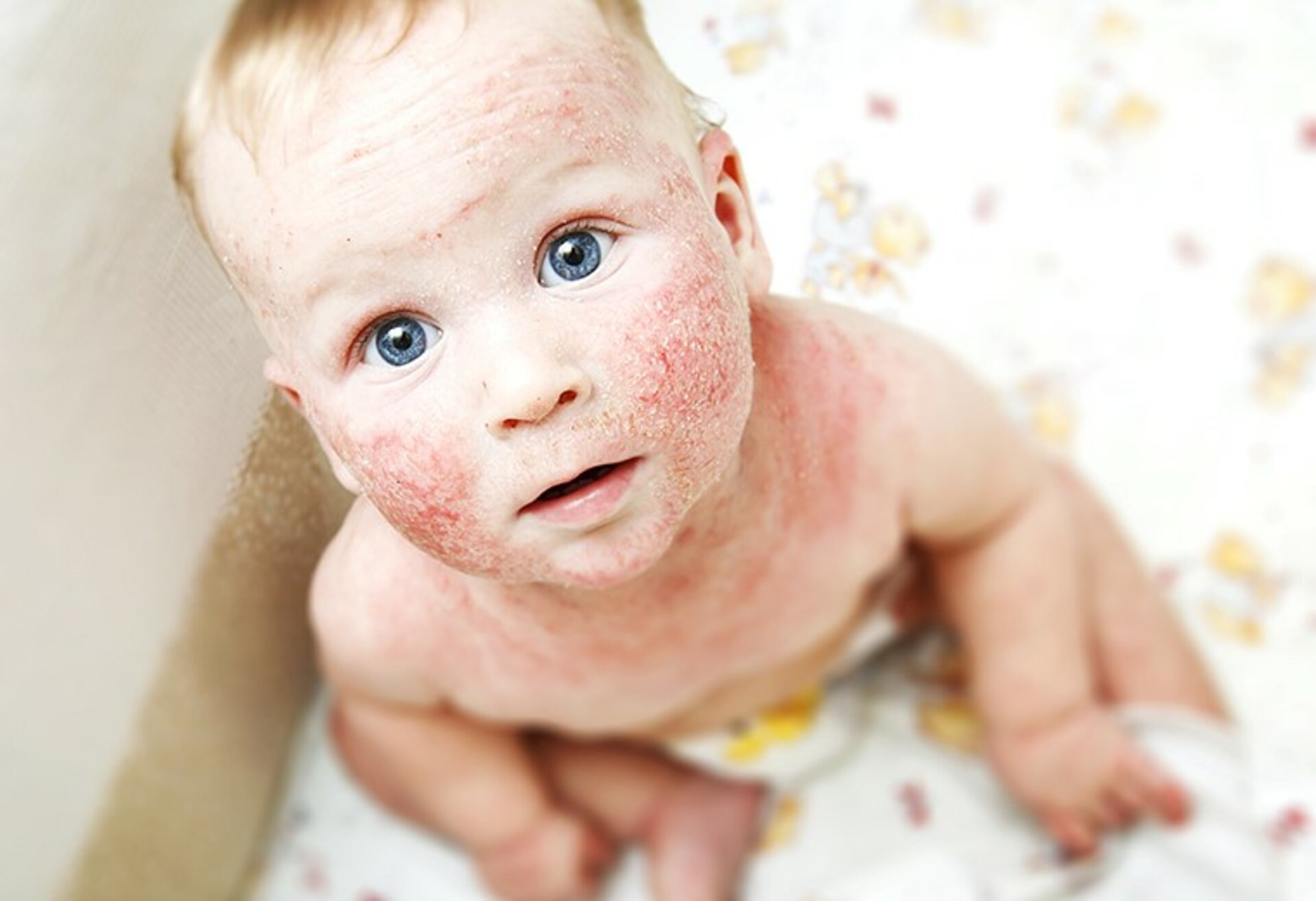 Baby mit geröteter, trockener Haut im Gesicht und am Oberkörper, das nach oben blickt – symbolische Darstellung einer gestörten Hautbarriere, wie sie bei Filaggrin-Genvarianten auftreten kann.